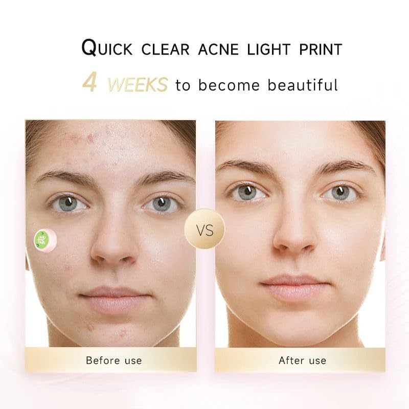 Electronic Acne Patches Light Therapy Pimple